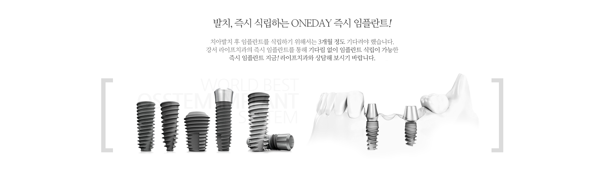 즉시 임플란트