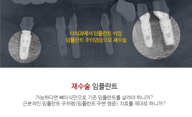 라이프치과 네비게이션임플란트