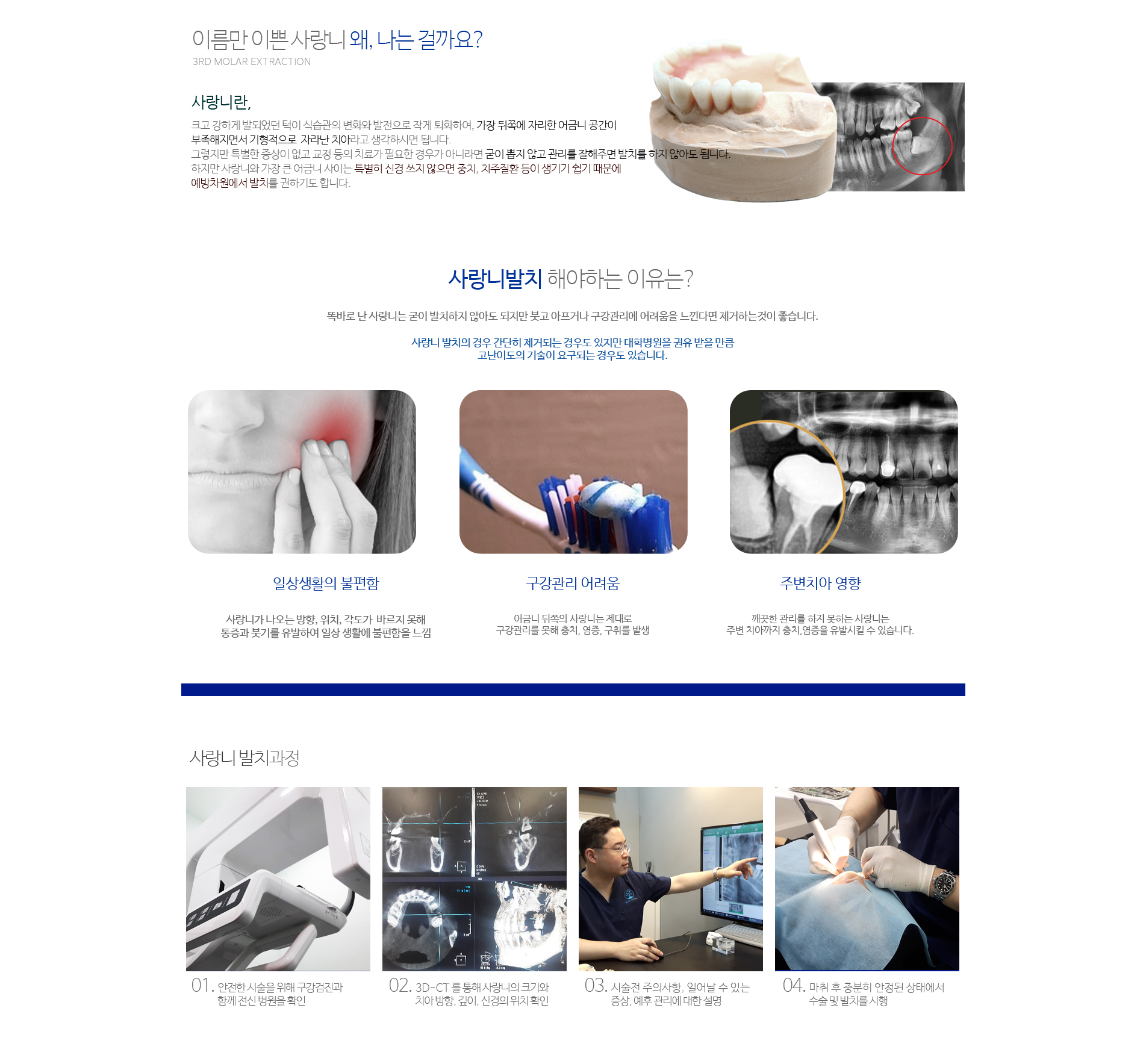 치석제거