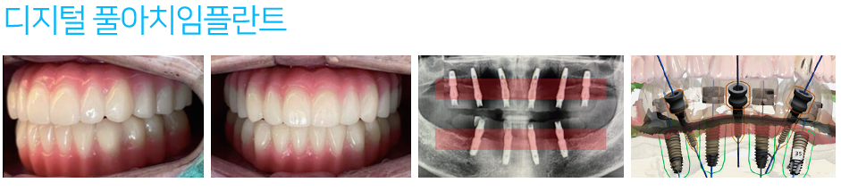 치과 디지털 임플란트