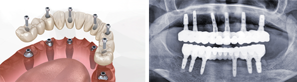 풀아치임플란트